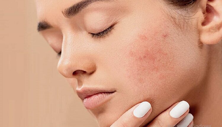 Acne Caused