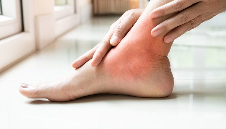 Home Remedies For Gout