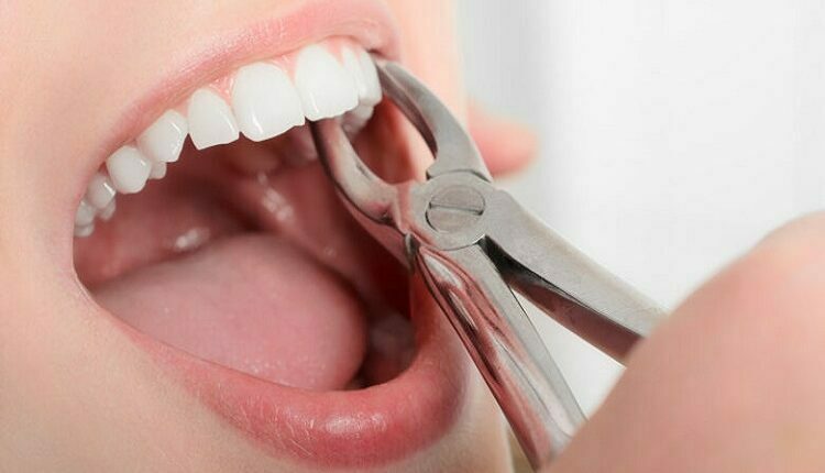 Alternatives To Dental Extraction