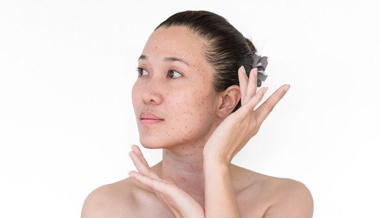 Skin Discoloration