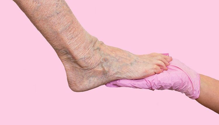 Vascular Diseases
