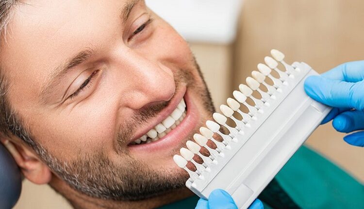 Dental Veneers